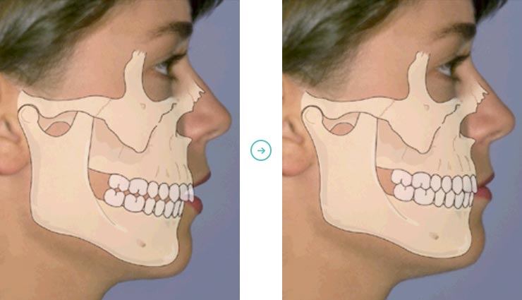 cirurgia-excesso-maxila